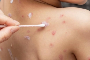 Chữa bệnh thuỷ đậu bằng cách nào?