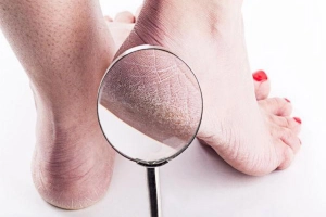Chữa lành, chăm sóc gót chân nứt nẻ lâu ngày