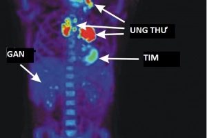 Chụp PET/CT: Mục đích và kỳ vọng