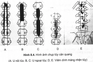 Chụp tủy sống cản quang có thể chẩn đoán bệnh gì?