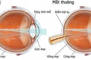 Có cách chữa cận 1 mắt hiệu quả nào?