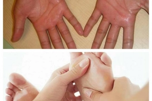 Có cách nào điều trị đổ mồ hôi tay chân?