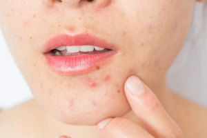 Có cách nào điều trị mụn nội tiết dứt điểm