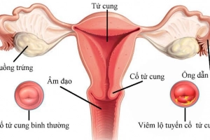 Có cần điều trị viêm lộ tuyến cổ tử cung khi mang thai?