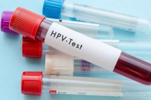 Có cần xét nghiệm tìm virus HPV trước khi tiêm vắc xin HPV không?