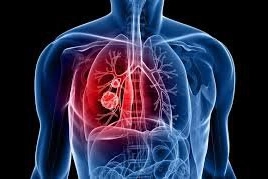 Có đốm đen trong phổi có nguy hiểm không?
