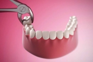 Có được nhổ 2-4 răng khôn cùng lúc?