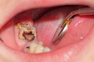 Có nên nhổ răng hàm bị sâu?