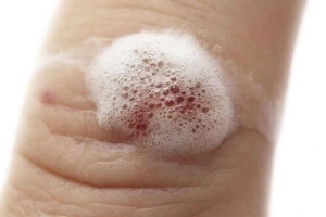 Có nên sử dụng nước oxy già trên da không?