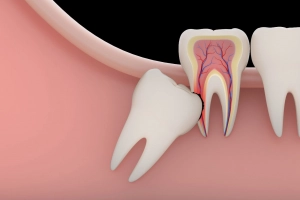 Có nhất thiết phải nhổ răng khôn không?