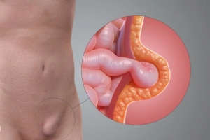 Có thể chữa thoát vị bẹn bằng đông y không?