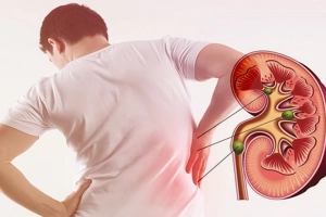 Có thể điều trị sỏi thận bằng thuốc nam?