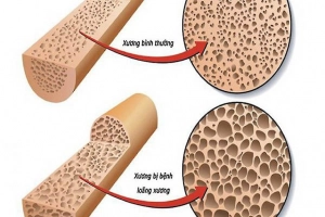 Cơ thể thiếu canxi có những biểu hiện gì?