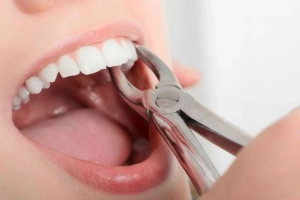 Có thể trồng răng sau khi nhổ răng hàm dưới 2 năm được không?
