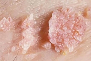 Condyloma là bệnh gì?