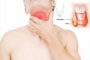 Cường giáp nên ăn gì, kiêng gì?
