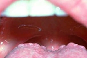 Cuống lưỡi nổi mụn nhỏ là dấu hiệu bệnh gì?