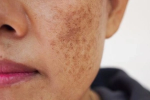 Da bị sạm đen- Nguyên nhân và cách chữa