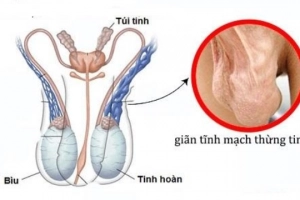 Đàn ông bị giãn tĩnh mạch thừng tinh có nên tập gym?