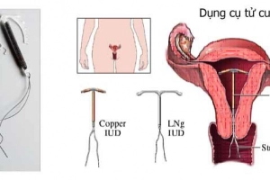 Đặt và tháo dụng cụ tử cung tránh thai