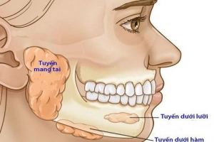 Đau do nhiễm trùng khoang dưới hàm