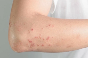 Dấu hiệu bệnh dị ứng không thể kiểm soát