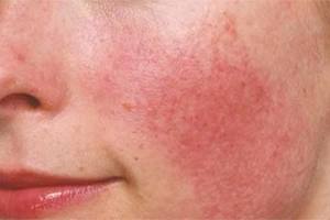 Dấu hiệu bị dị ứng ở mặt