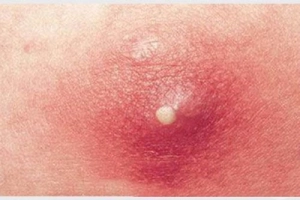 Dấu hiệu mụn nhọt bị nhiễm trùng