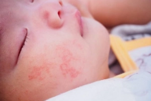 Dấu hiệu nấm da ở trẻ sơ sinh