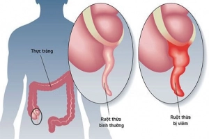 Dấu hiệu sớm nhất khi đau ruột thừa