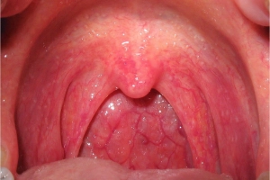 Đau họng khi ngủ dậy kèm không ngửi được mùi là dấu hiệu bệnh gì?
