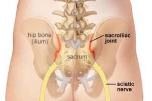 Đau khớp cùng chậu: Những điều cần biết