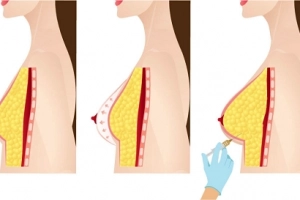 Đau nhức ngực sau nâng ngực bằng mỡ tự thân phải làm sao?
