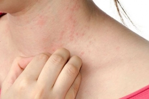 Dị ứng với Paracetamol phải làm sao?