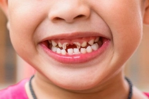 Điều gì xảy ra khi bạn không đánh răng