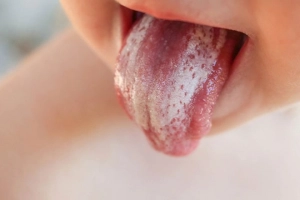 Điều trị bệnh nấm lưỡi ở người lớn và trẻ em
