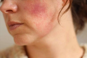 Điều trị da nhiễm corticoid