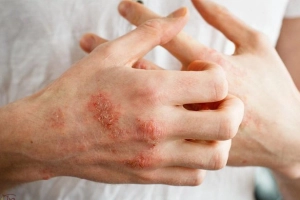 Điều trị dứt điểm ghẻ chàm hóa như thế nào?