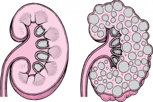 Điều trị dứt điểm nang thận như thế nào?