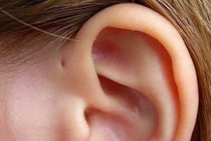 Điều trị dứt điểm rò luân nhĩ thế nào?