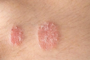 Điều trị dứt điểm vảy nến kéo dài như thế nào?