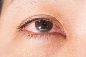 Điều trị dứt điểm viêm kết mạc thế nào?