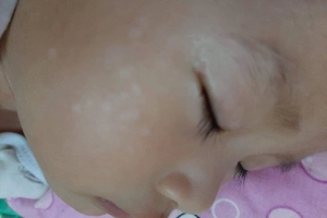 Điều trị lang ben vùng mặt cho trẻ 10 tháng tuổi như thế nào?