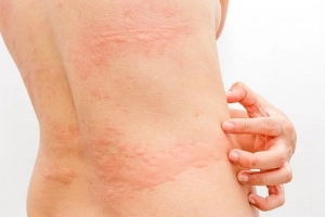 Điều trị mày đay kéo dài như thế nào?