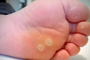 Điều trị mụn cóc đúng, tránh lây lan