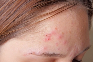 Điều trị mụn trứng cá đỏ