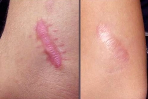 Điều trị sẹo lồi thế nào?
