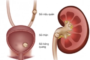 Điều trị sỏi niệu quản đoạn trên kích thước 10mm như thế nào?