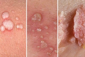 Điều trị sùi mào gà sinh dục ở nhiều vị trí khác nhau