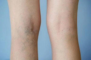 Điều trị suy giãn tĩnh mạch chi dưới như thế nào?